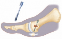 Нові види операцій по корекції вальгусной деформації (випирає «кісточка» на пальцях ніг)