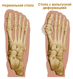 Нові види операцій по корекції вальгусной деформації (випирає «кісточка» на пальцях ніг)