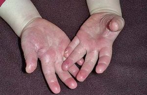 Pielea de pe degetele copilului va fi tratată, pielea tratată