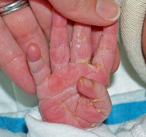 Pielea de pe degetele copilului va fi tratată, pielea tratată