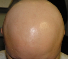 Alopecia areata, sau alopecia areata