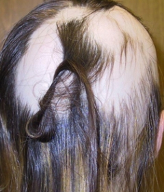 Alopecia areata, sau alopecia areata