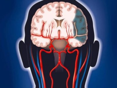 agydaganat ahogy élnek a műtét után (a tumor) agydaganat ahogy élnek a műtét után