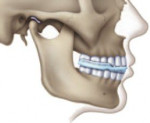 Ортотік в анапе як метод лікування нейром'язової дісфунціі і змін у верхній і нижній щелепі