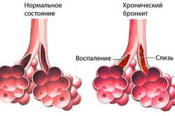 Ускладнення бронхіту лікування і наслідки