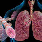 Szövődményei krónikus bronchitis a felnőtt kezelési