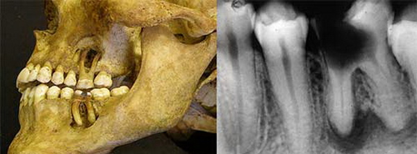 Osteoporoza, boala maxilarului, tratamentul stomatologic