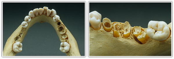 Osteoporoza, boala maxilarului, tratamentul stomatologic