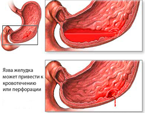 Ulcer gastric acut și bulă duodenală