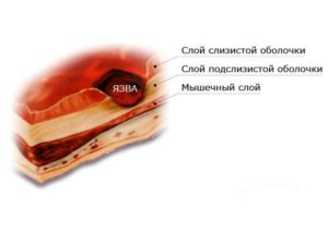 Ulcer gastric acut și bulă duodenală