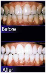 Sistem de albire a dinților