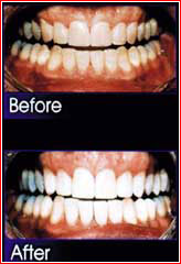 Sistem de albire a dinților