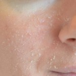 Peeling facial