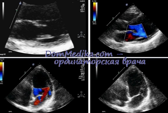 Insulele cardiace după radioterapie