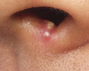 Pimple în nas, cauze, tratament și prevenire