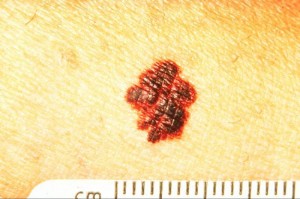 Prognoza de supraviețuire cu melanomul pielii 1, 2 etapă