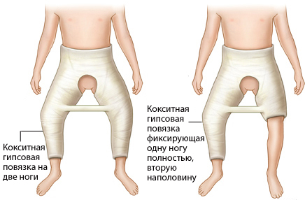 Прогресуюча дисплазія кульшового суглоба, медичний портал eurolab