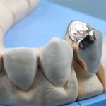Протезування зубів в Санкт-Петербурзі ціни, відгуки, фото, відео