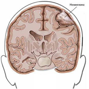 Cancerul creierului și membranele acestuia