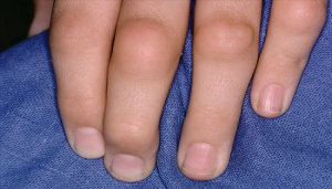 Реактивний артрит тазостегнового суглоба у дітей методи діагностики, лікування