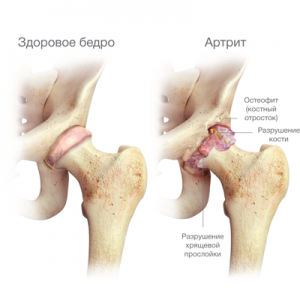 Artrita reactivă a articulației șoldului la copii, metode de diagnosticare, tratament