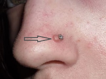 Conuri cu piercing-nas - cauze, granulom, cicatrice keloid