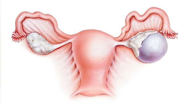 Simptomele chistului ovarian la femei