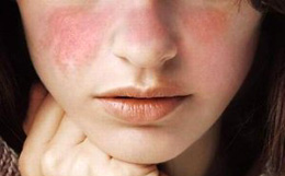 Simptomele lupusului eritematos pe față - cauzele și tratamentul bolii