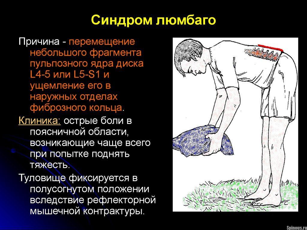 Simptomele sindromului Lumbago și tratamentul la domiciliu