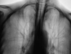 Szindróma mellhártya megvastagodása, a radiológusok portál