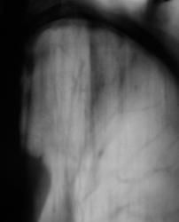 Sindromul de îngroșare a pleurei, portal de radiologi