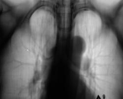 Sindromul de îngroșare a pleurei, portalul radiologilor