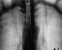 Sindromul de îngroșare a pleurei, portalul radiologilor