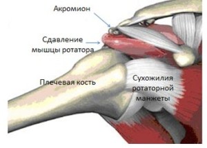 Sindromul subacromial al articulației umărului