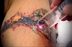 Татуювання і їх видалення - все що потрібно знати