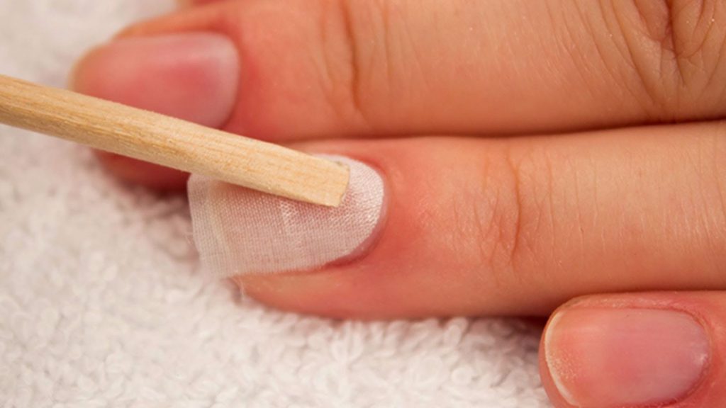 Тріщина на нігті - причини і лікування тріщин близько нігтів, що робити при тріщині нігтя руки