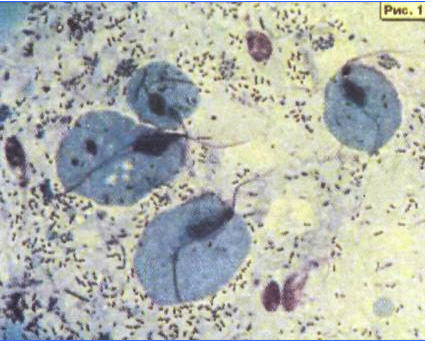 Trichomonasis - urolog-androlog