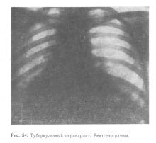 Poliserozita tuberculozei, tuberculoza