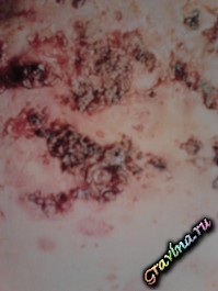 Acne vulgaris, acnee vulgaris