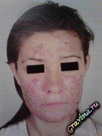 Acne vulgaris, acnee vulgaris