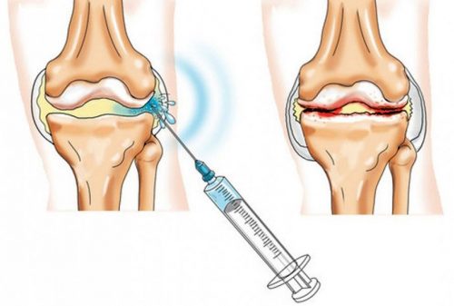 Injecții în articulația genunchiului cu artroză