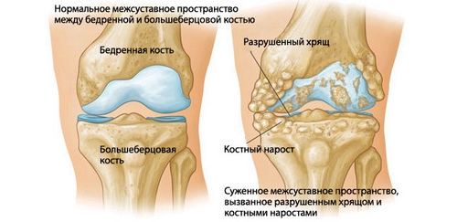 Injecții în articulația genunchiului cu artroză