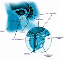 Види вузлів в передміхуровій залозі і способи їх лікування