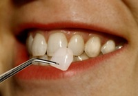 Вініри для зубів - шкідливі або безпечні
