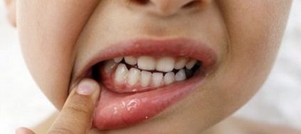Inflamația gingiilor la copii, cauze și metode de tratament