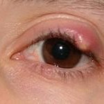 Запалення очі лікування народними засобами, народна медицина