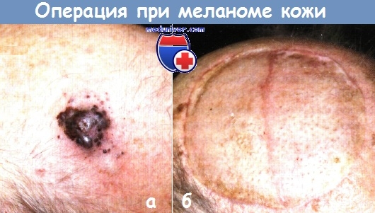 Tratamentul chirurgical al melanomului cutanat