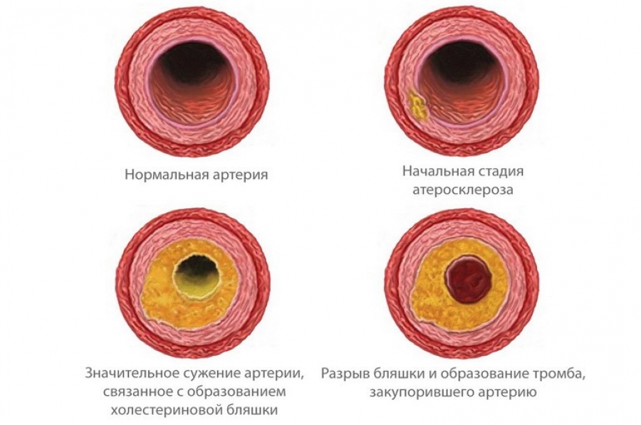 Plachetele de colesterol din vasele și arterele creierului, coloanei vertebrale, gâtului, membrelor,