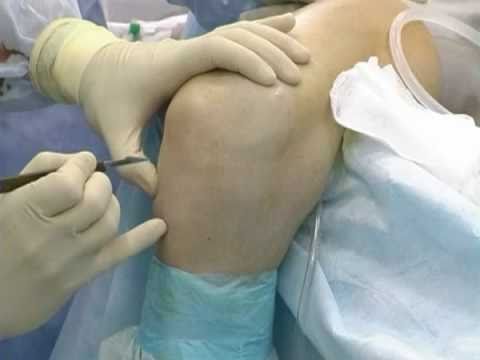 Chondromalacia a articulației genunchiului ceea ce este, tratament, grade de dezvoltare, remedii folclorice