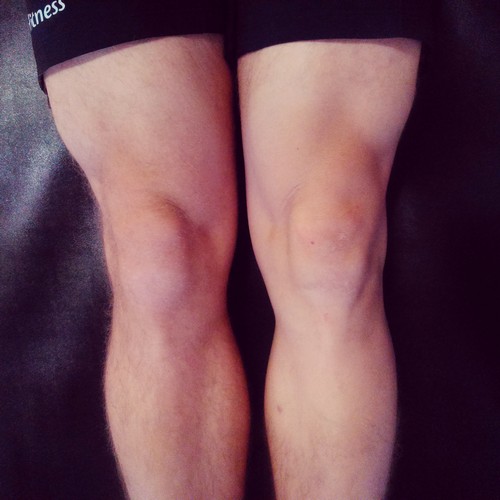 Хондромаляція колінного суглоба що це таке, лікування, ступеня розвитку, народні засоби